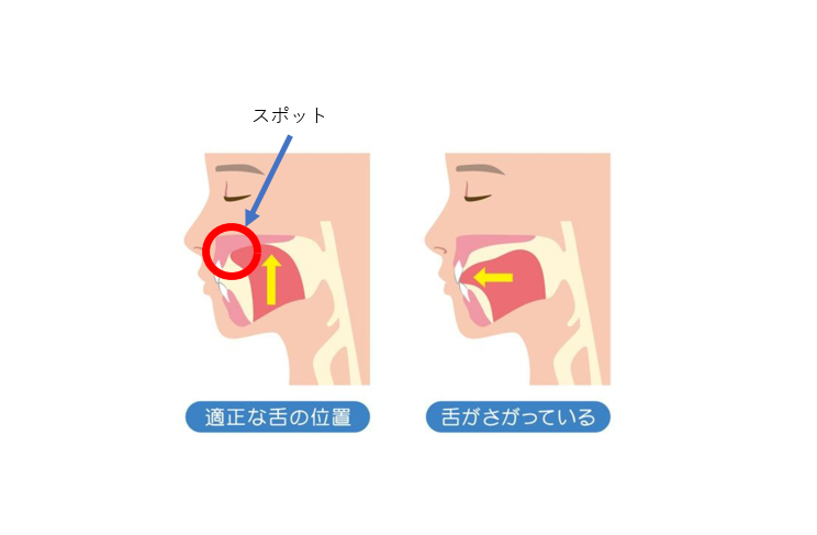 低位舌と歯並びの関係